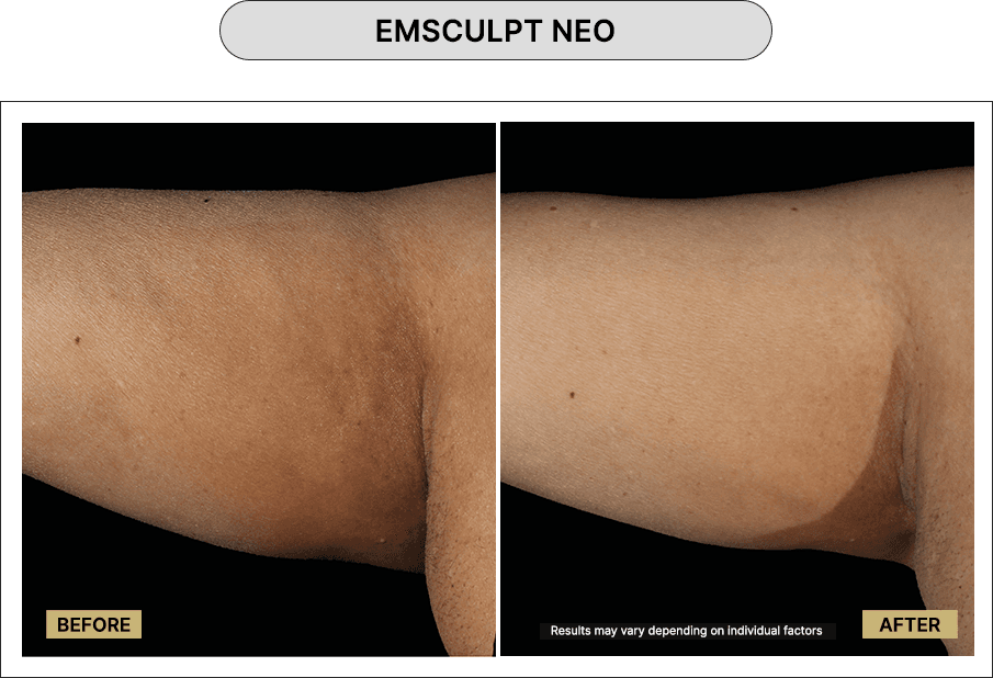 Emsculpt NEO