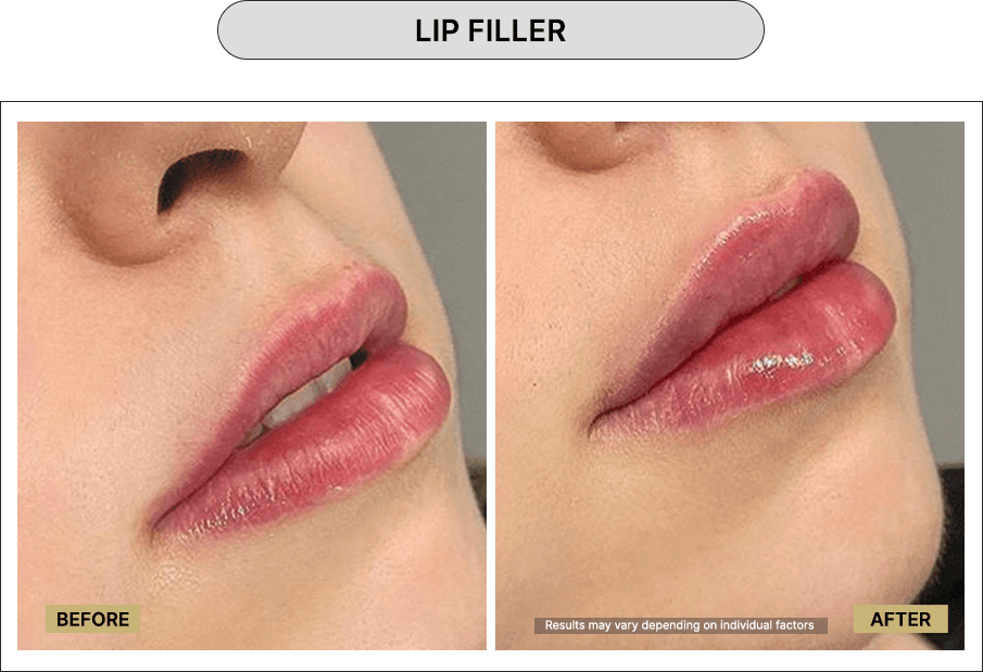 Lip Filler