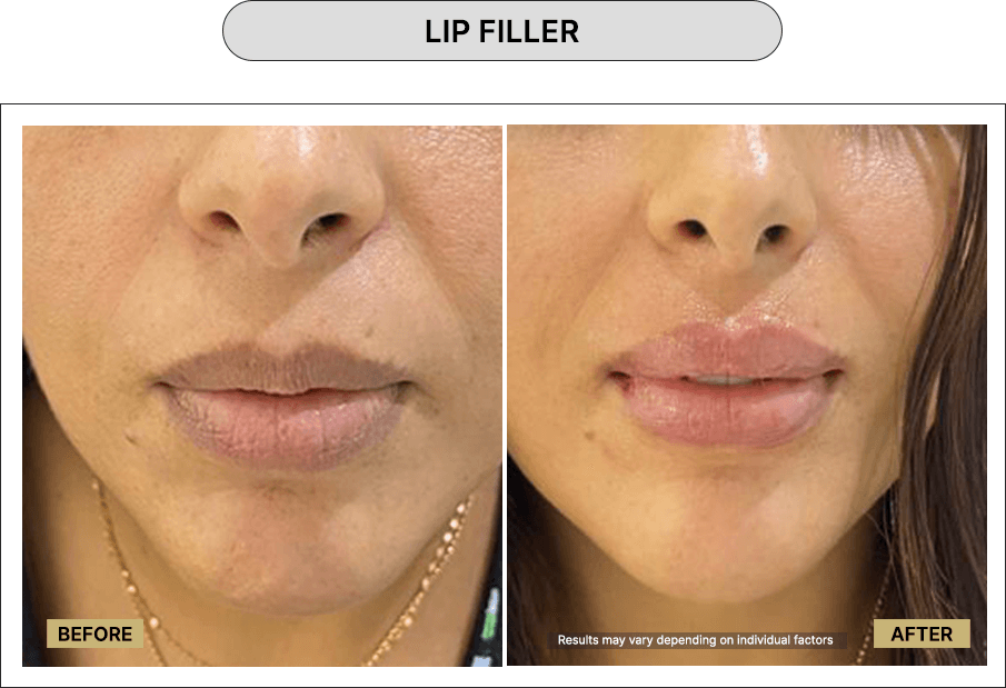 Lip Filler