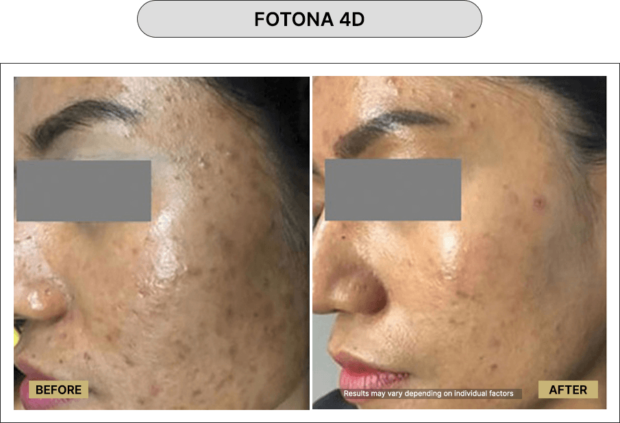 Fotona 4D