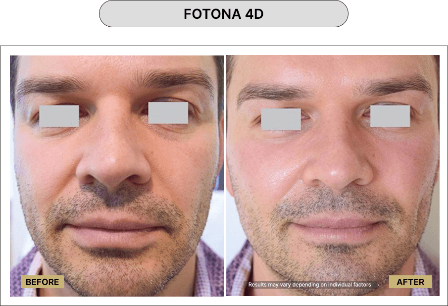 Fotona 4D