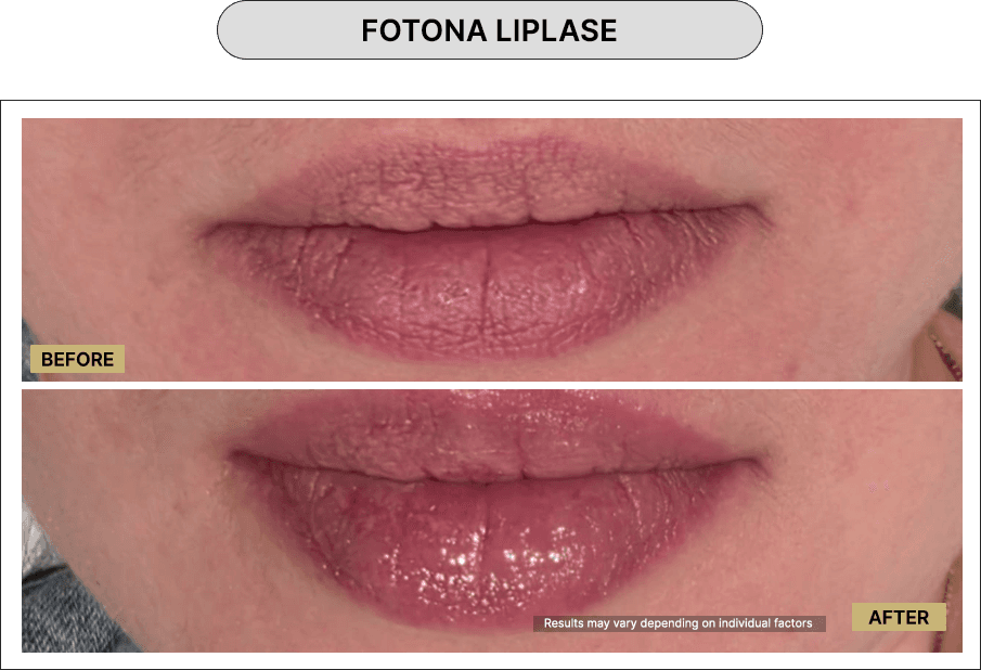 Fotona Liplase