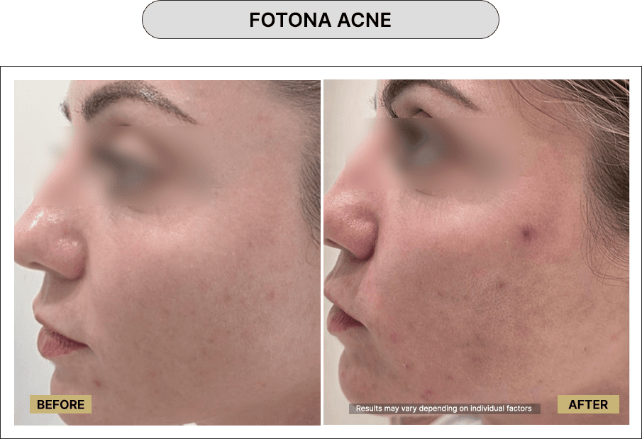 Fotona Acne
