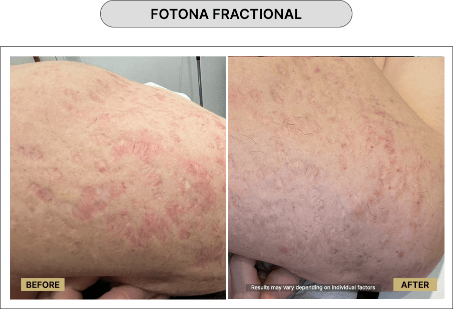 Fotona Fractional