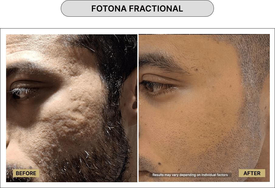 Fotona Fractional