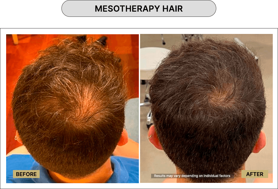 Mesotherapy hair