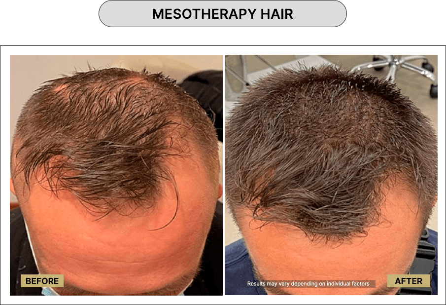 Mesotherapy hair