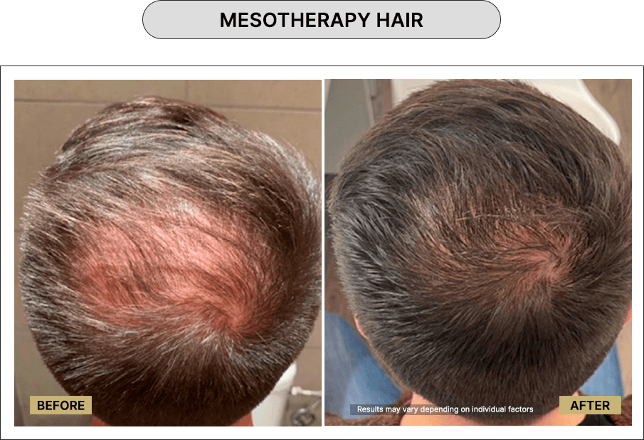 Mesotherapy hair