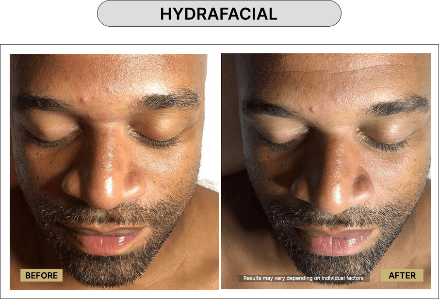 Hydrafacial