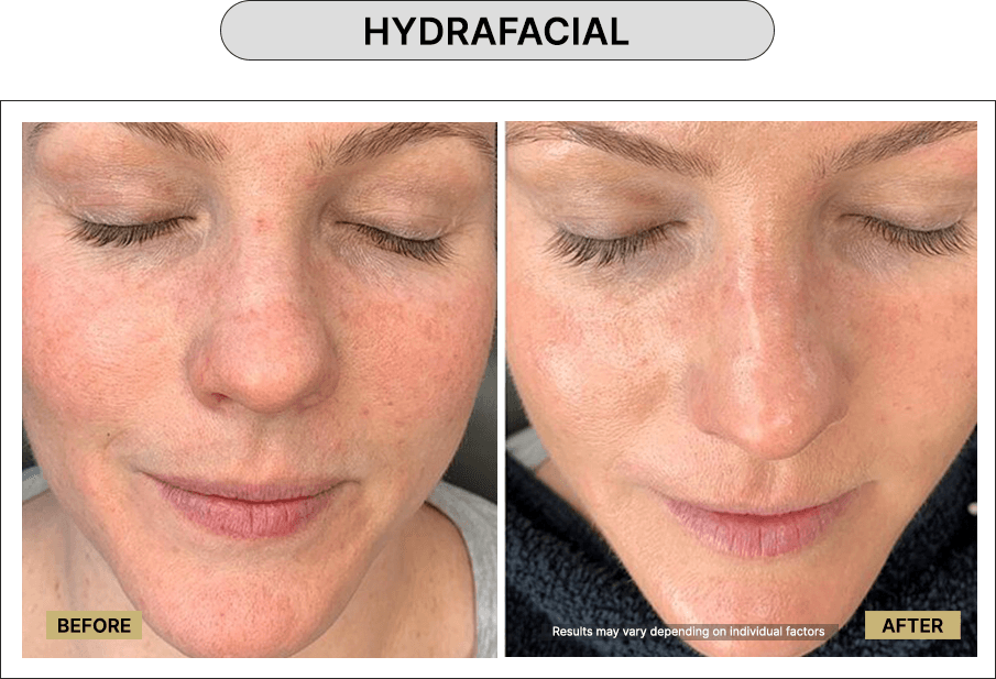 Hydrafacial