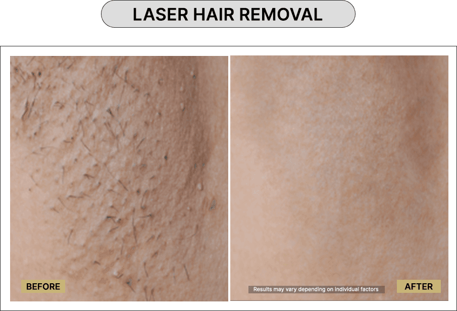 Laser Hair Removal