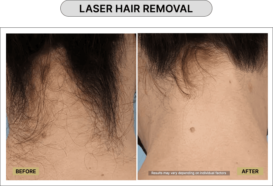 Laser Hair Removal
