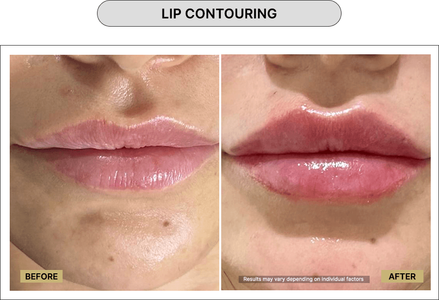 Lip Contouring