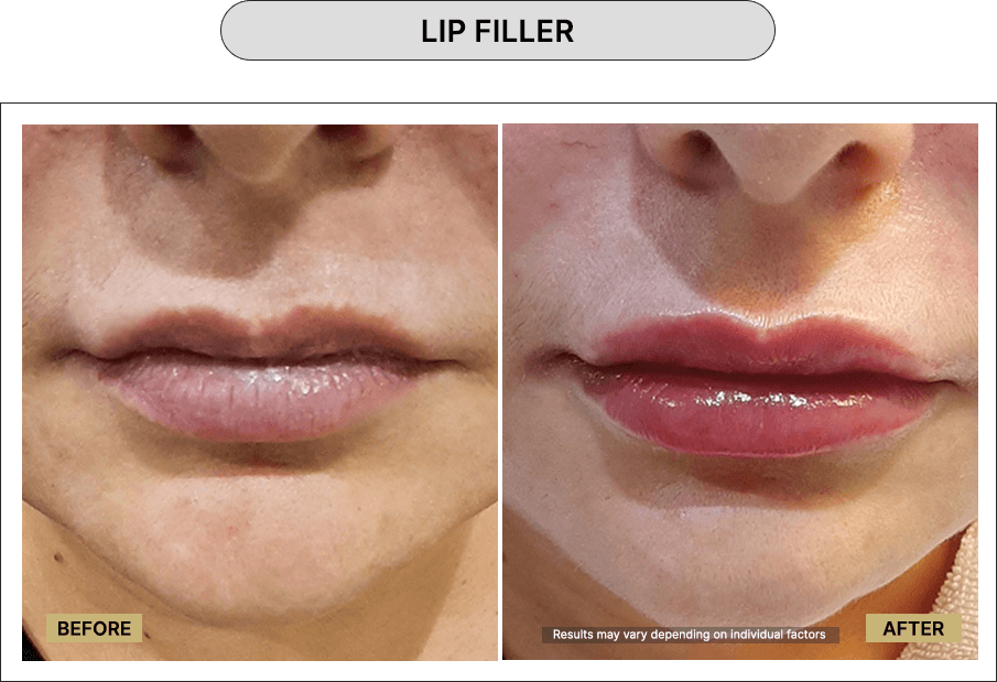 Lip Filler