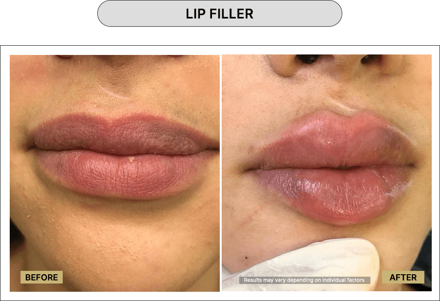 Lip Filler