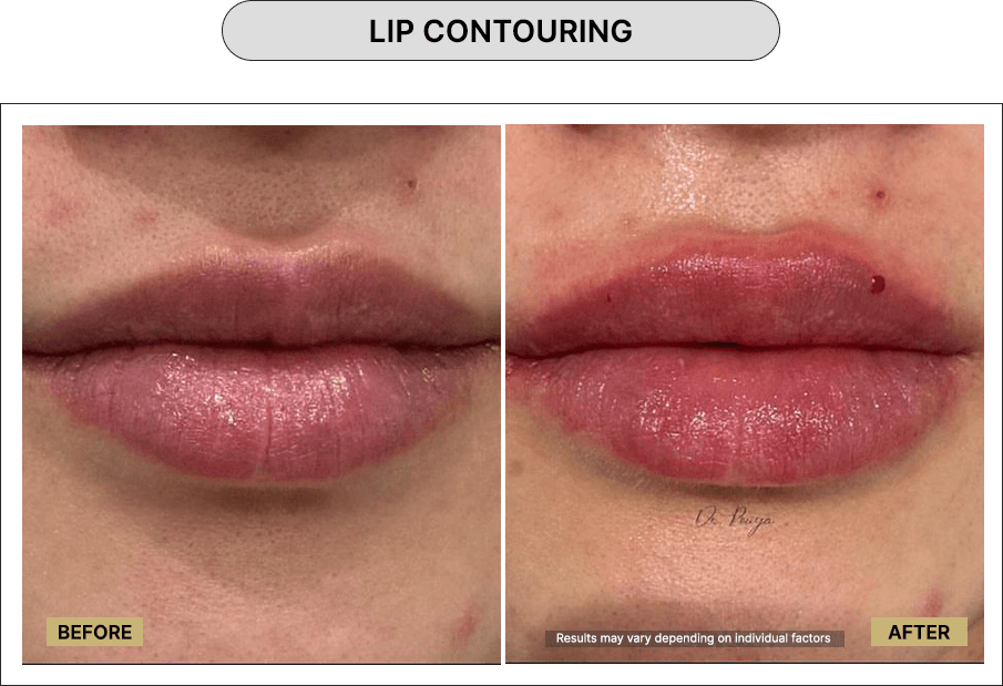 Lip Contouring