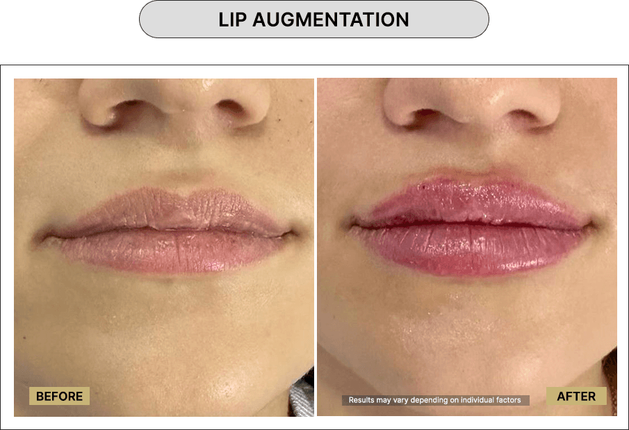 Lip Augmentation