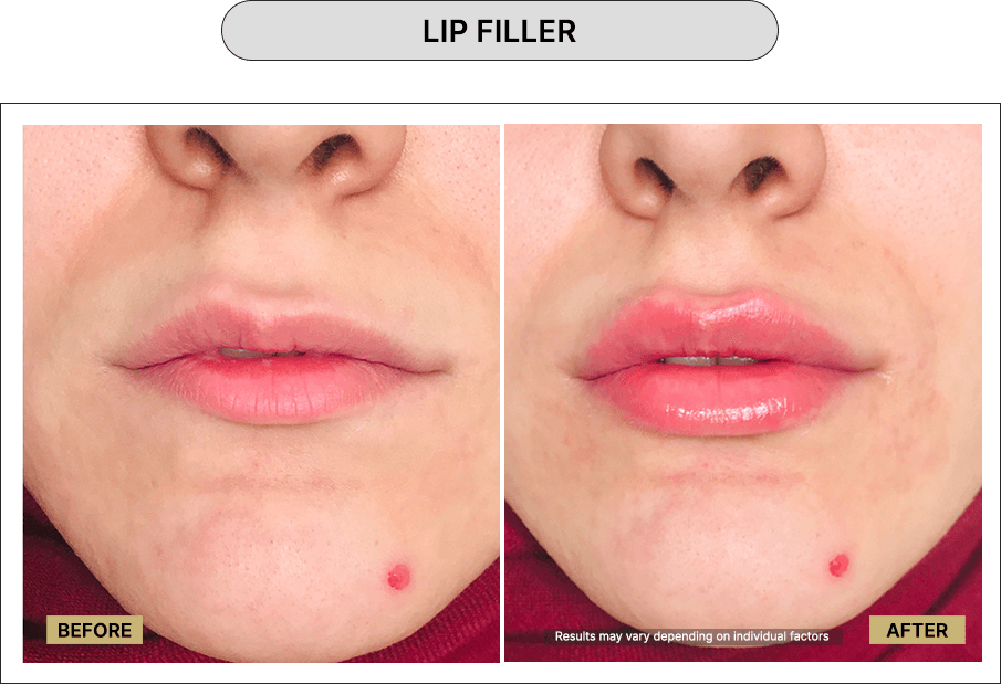 Lip Filler