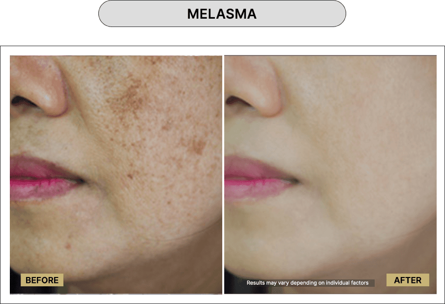 Melasma