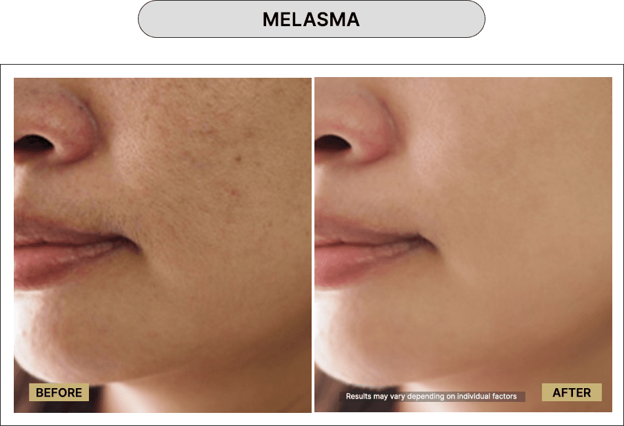 Melasma