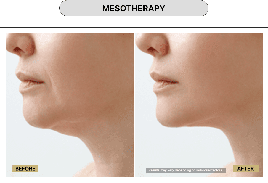 Mesotherapy