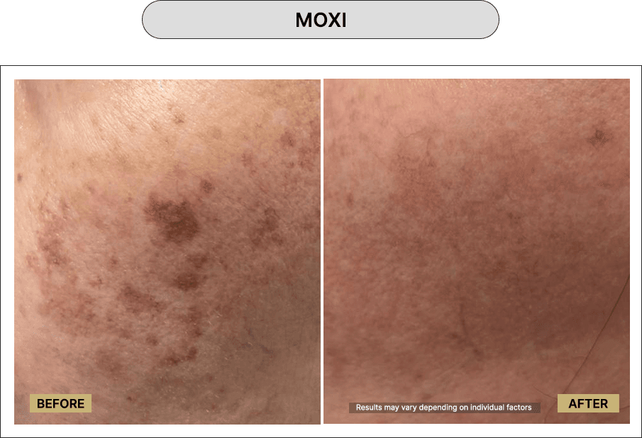 Moxi