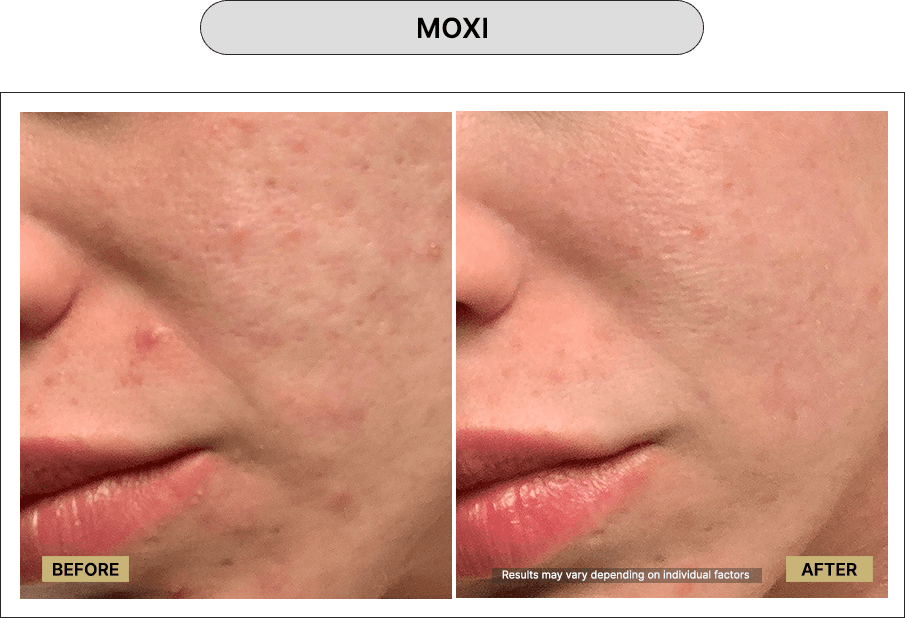 Moxi
