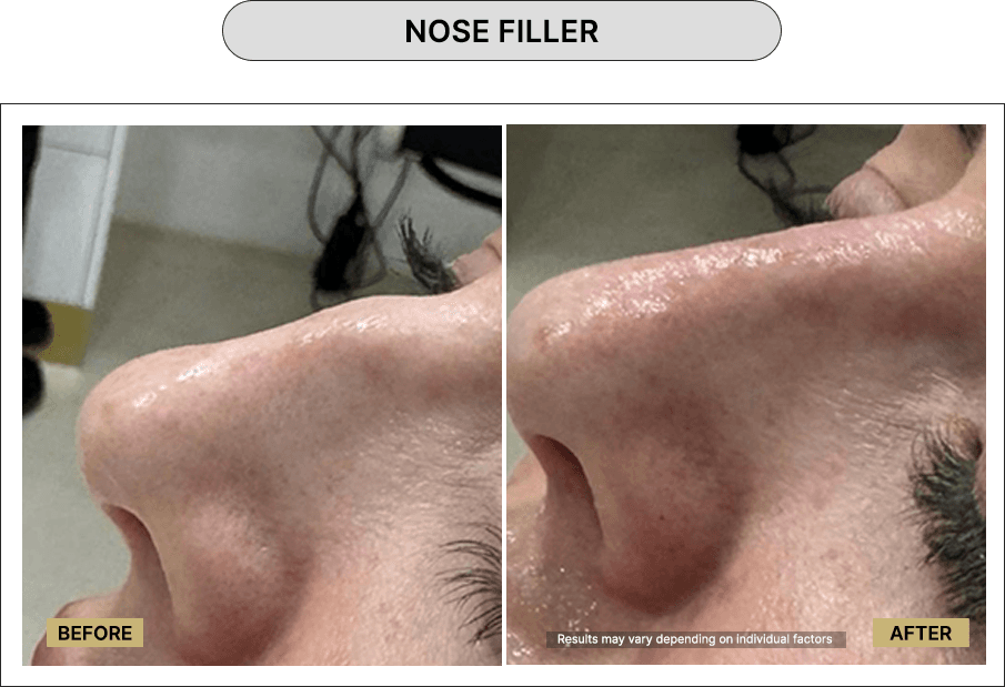 Nose Filler