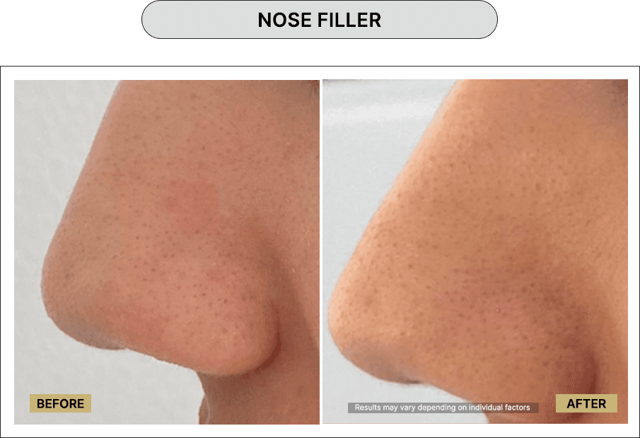 Nose Filler