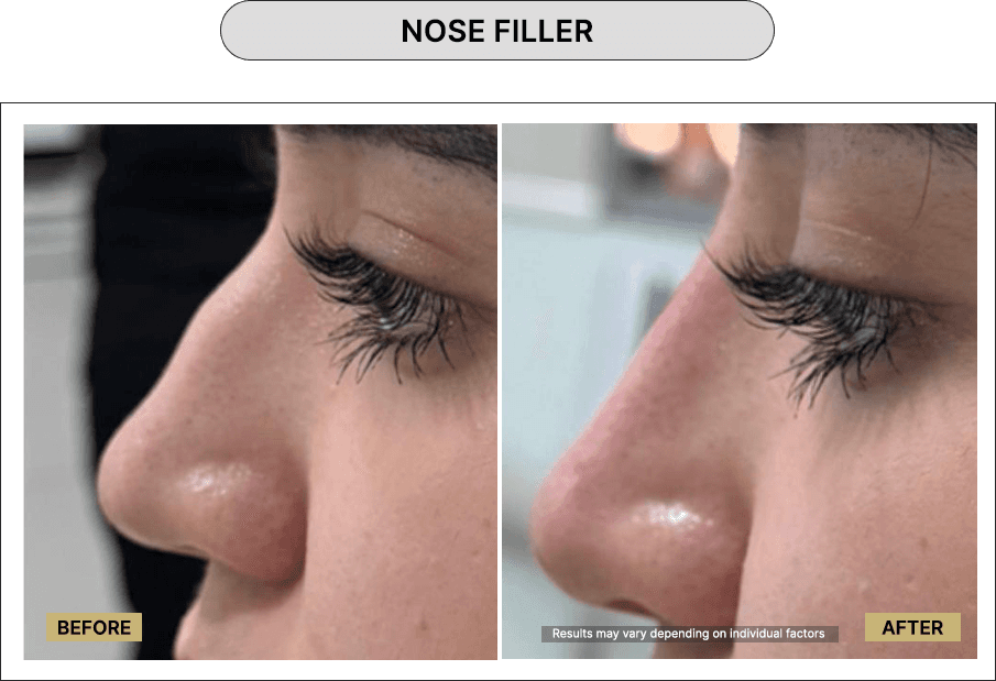 Nose Filler