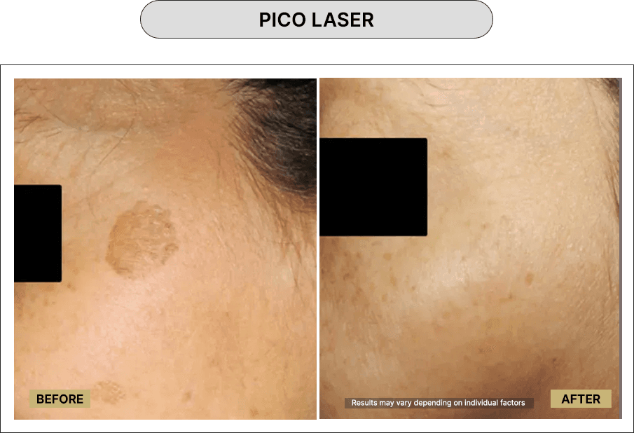 Pico Laser