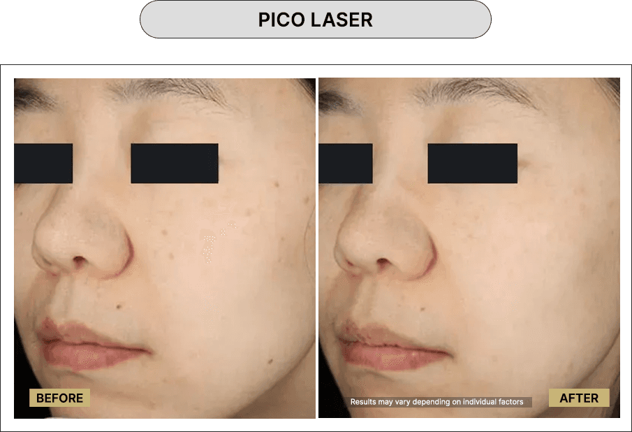 Pico Laser