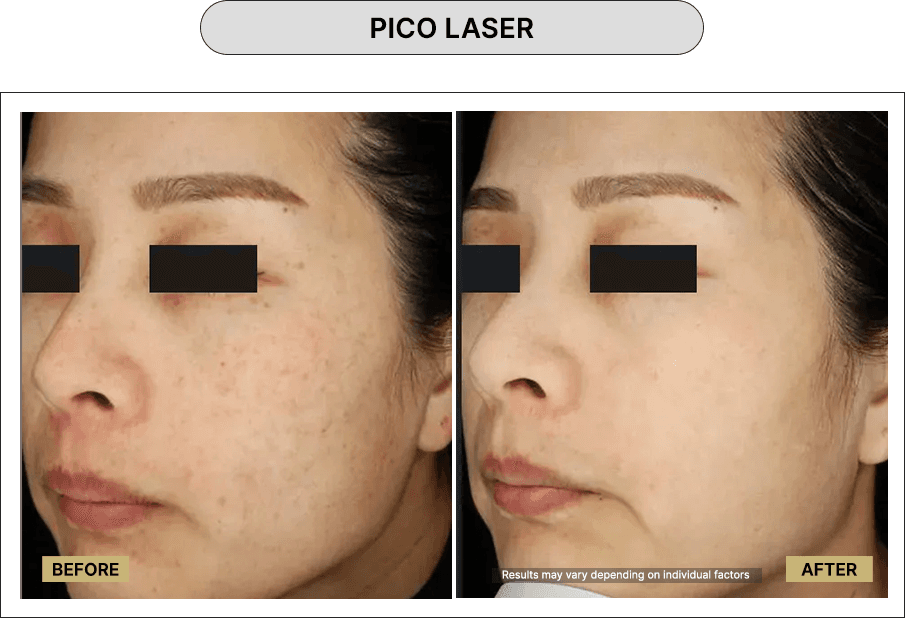 Pico Laser