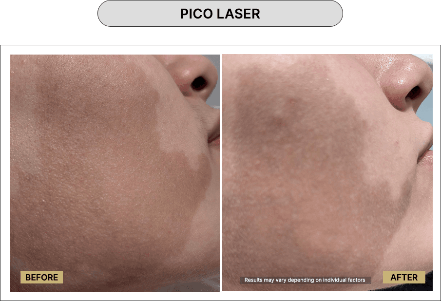 Pico Laser