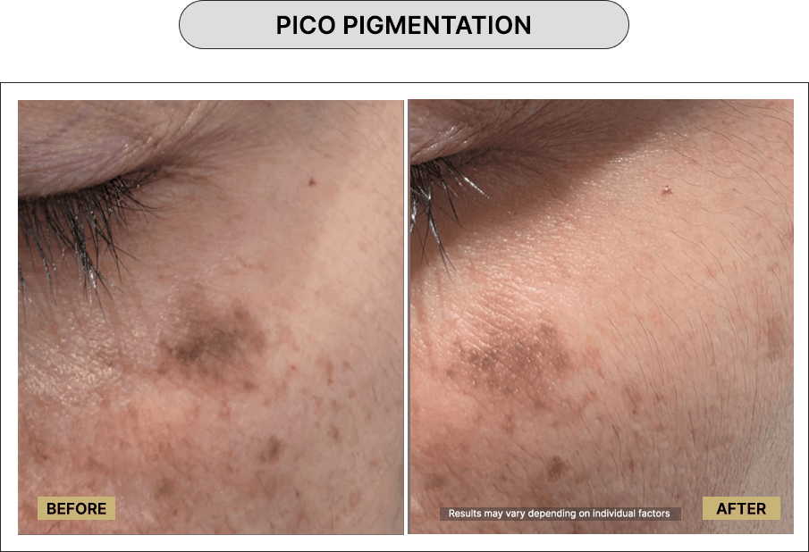 Pico Pigmentation