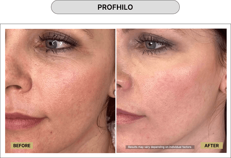 Profhilo