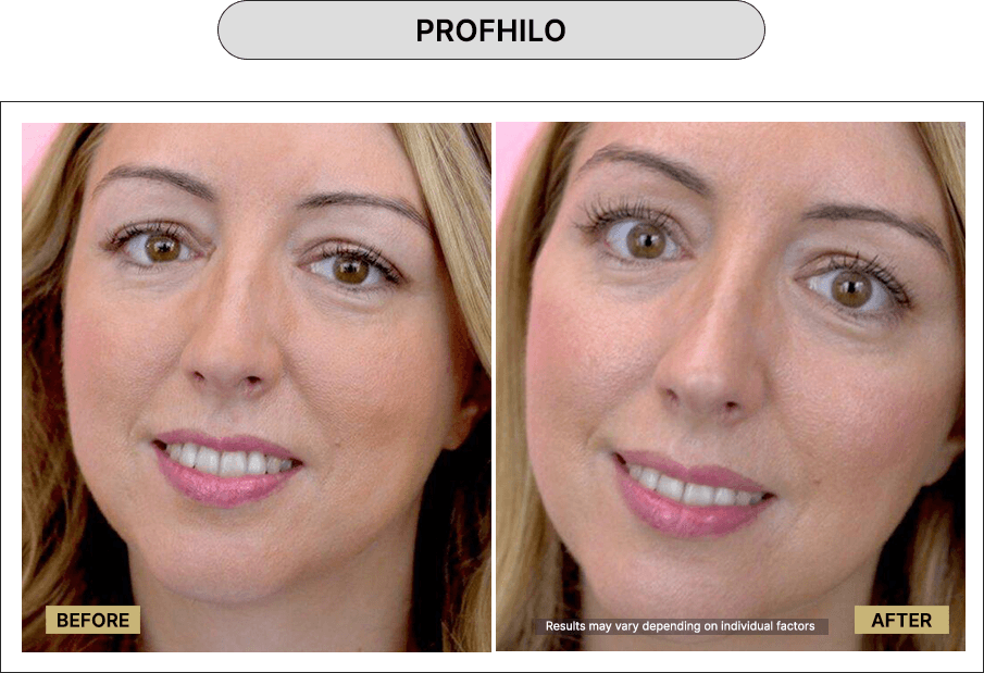 Profhilo