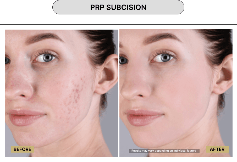 PRP Subcision