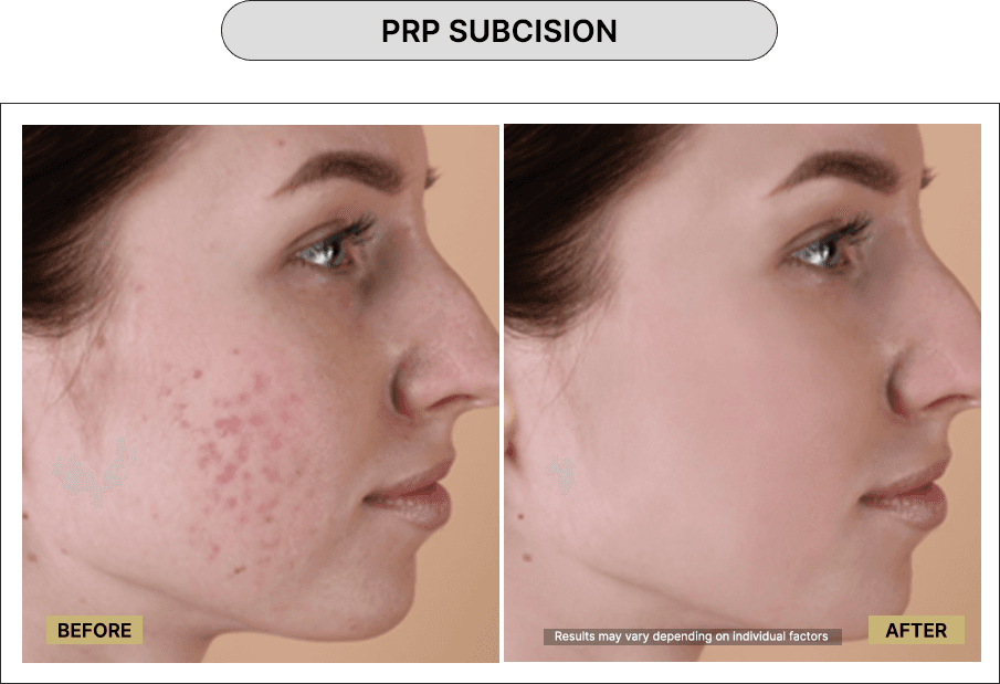 PRP Subcision