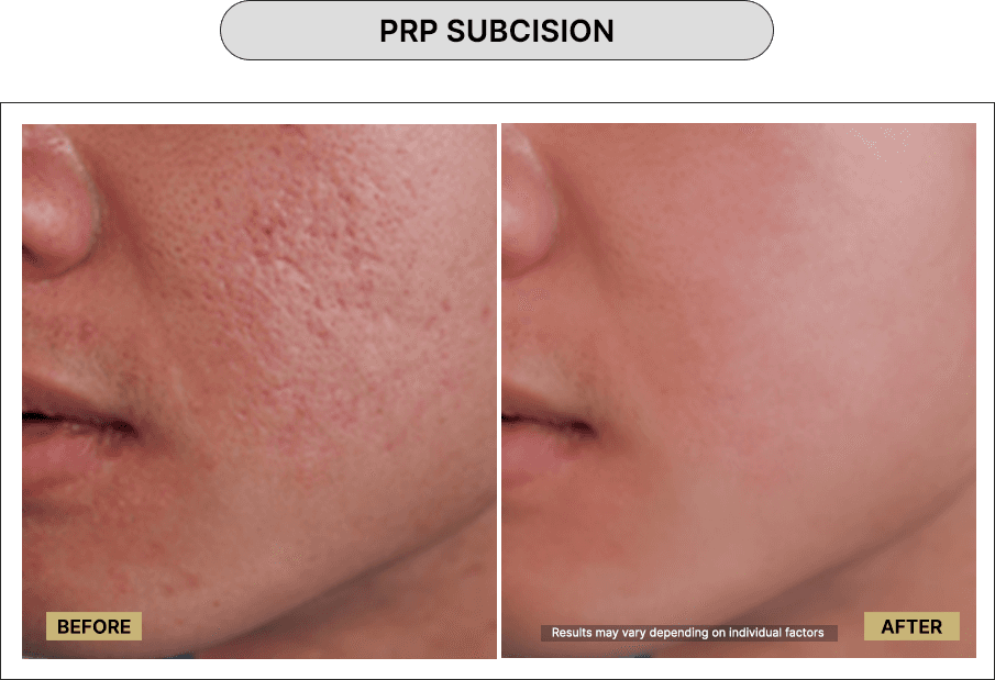 PRP Subcision