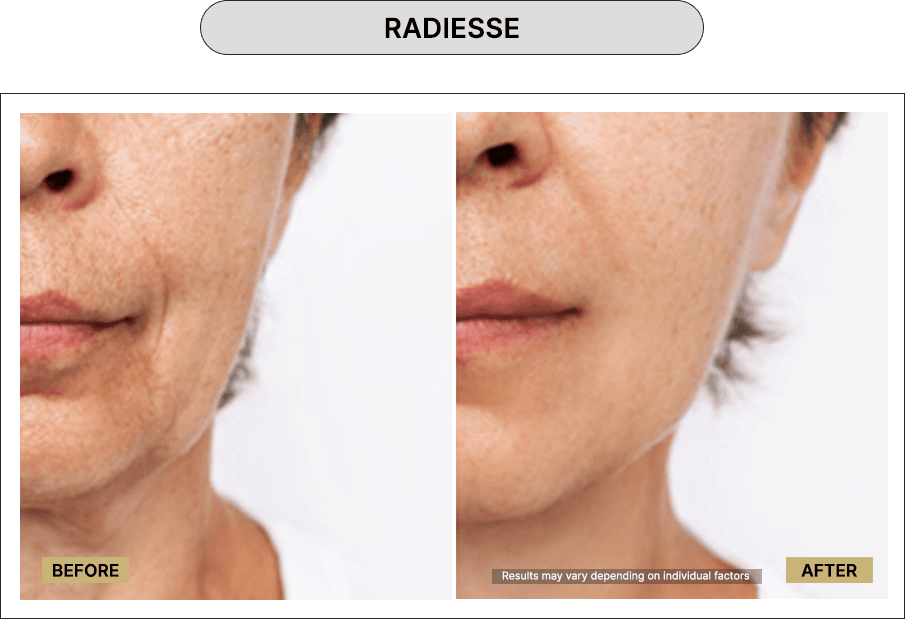 Radiesse