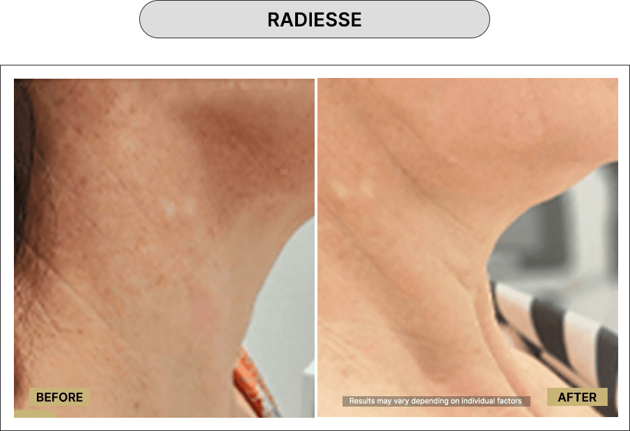 Radiesse