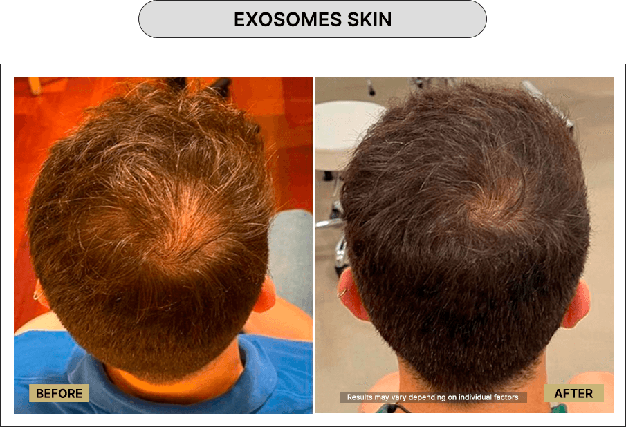 Exosomes Skin