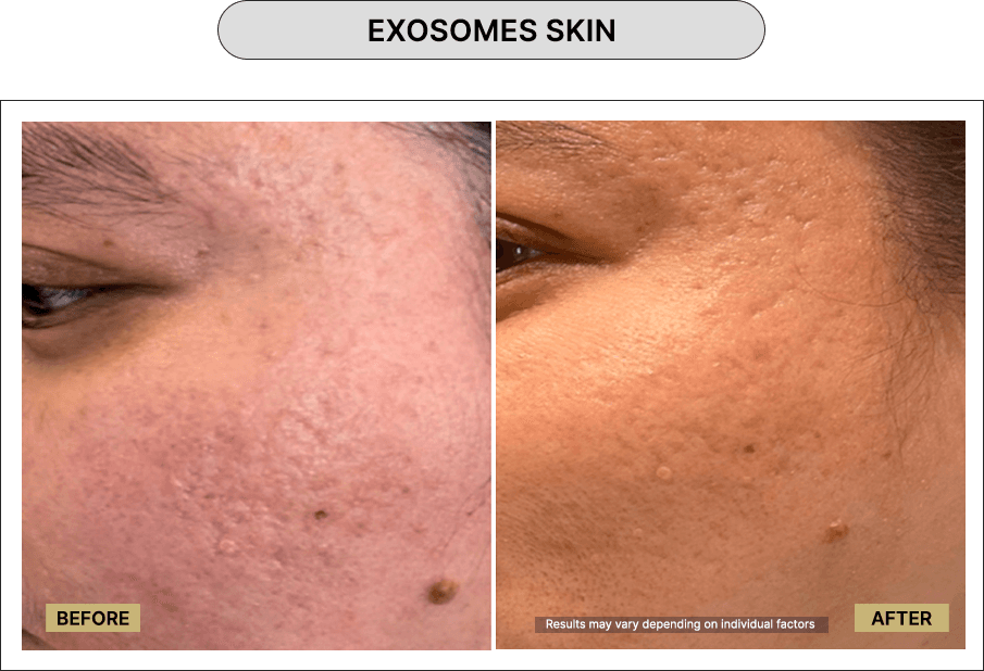 Exosomes Skin