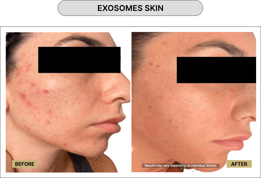 Exosome Skin