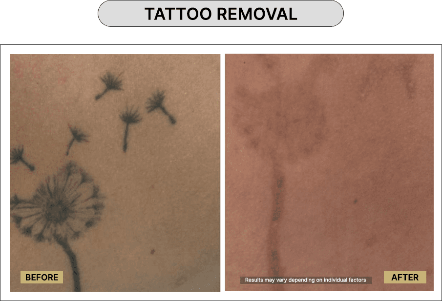 Tattoo Removal