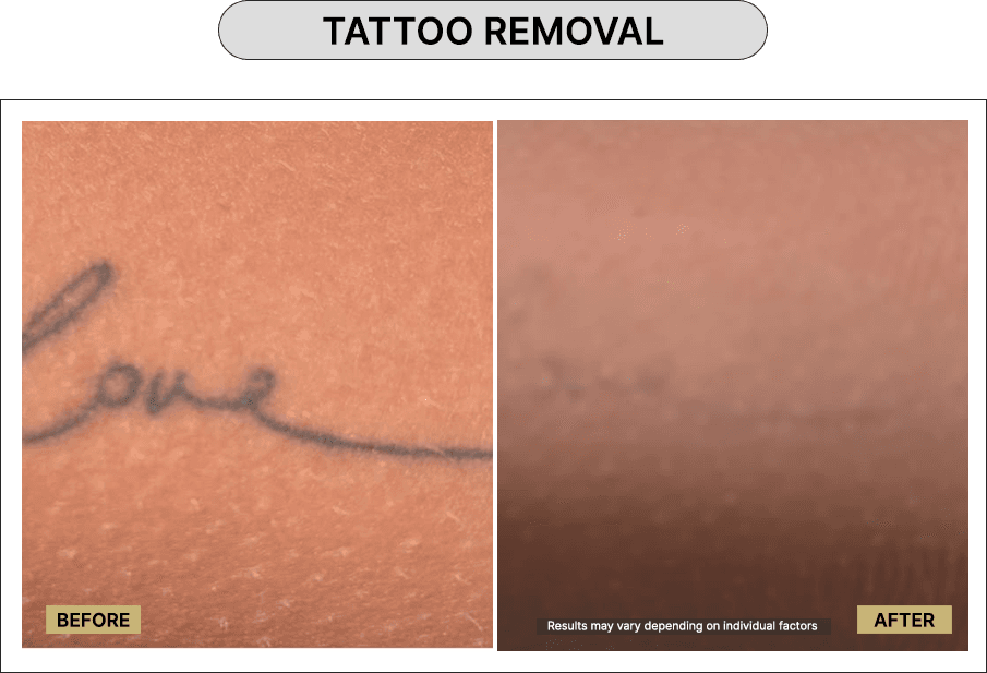 Tattoo Removal