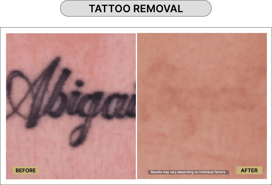 Tattoo Removal