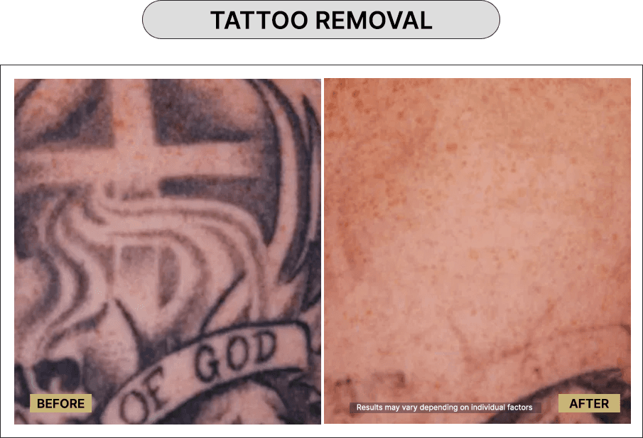 Tattoo Removal