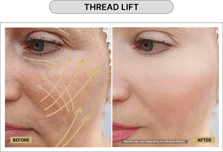 Thread Lift